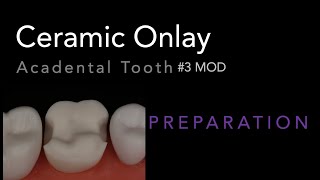 MOD Ceramic Onlay 3 Acadental  Dr Richard Stevenson [upl. by Tomlinson368]