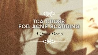 TCA CROSS for acne scarring [upl. by Neeham]