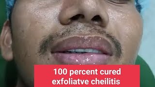 100 percent cured exfoliatve cheilitis treated by Laser and some medicines [upl. by Bentley]