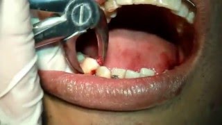 HUETEDENTAL Exodoncia de Premolares inferiores  34 y 44  Dr Rigoberto Huete [upl. by Eenahc]