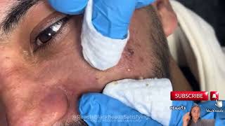 blackheads extractions blackheads and whiteheads removal blackheads new this week [upl. by Alakcim731]