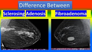 Difference Between Sclerosing Adenosis and Fibroadenoma [upl. by Lecia775]