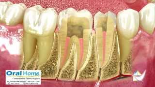 Endodoncia o tratamiento de conducto [upl. by Artemisa937]