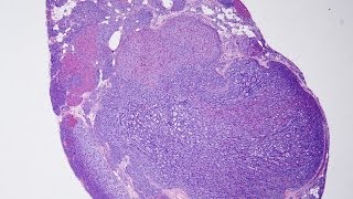 Parathyroid disease  Pathology mini tutorial [upl. by Francisco]