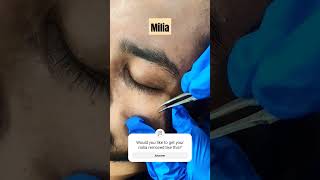 MILIA removal by Dr Sanchika Gupta 👩‍⚕️ dermatologistinfaridabad [upl. by Ennayar]