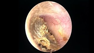 Ear cleaning video 2019113 [upl. by Ydissak]