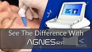 The Benefits of AGNES RF  How does Precision RF Microneedling Work [upl. by Weiler]