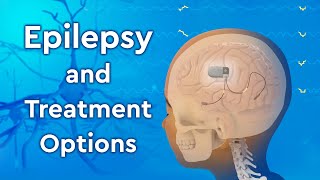 What is Epilepsy and How is it Treated [upl. by Adnimra]