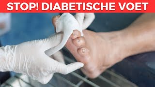 5 Symptomen Van Een Diabetische Voet  Tips Voor Een Behandeling [upl. by Rhona]