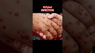 🦠 HPylori Infection Explained 😷 stomach infection shorts [upl. by Aiotal]