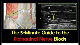 Ilioinguinal Nerve Block  A HowTo Guide [upl. by Atrebla811]