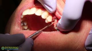 Bone Grafting for Socket Preservation [upl. by Edwine112]