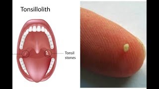 Tonsilloliths tonsil stones a patient education video by Carlo Oller MD [upl. by Constant]