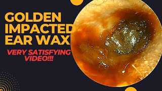 GOLDEN Ear Wax Removal VERY SATISFYING Video [upl. by Emilee]