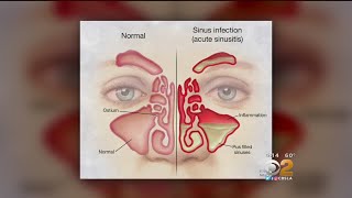 Doctor Tried And True Methods For Sinus Relief Are Still Best [upl. by Torp]