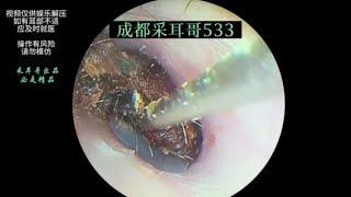 采耳哥Ear wax removalsatisfying video for ear Fungus cleaning  533 [upl. by Muryh]