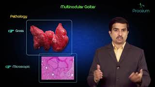 Multinodular goitre  Usmle step 1 pathology lecture and case presentation [upl. by Einrae547]