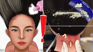 ASMR Satisfying Scalp Scaling Care Animation‼️Get rid of tons of head licd Blackhead [upl. by Wanyen]