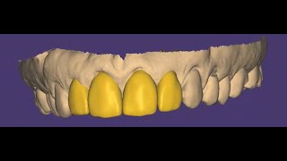 Occlusal Equilibration and Wax Up 710 in ExoCAD [upl. by Avilla]