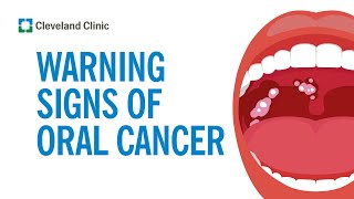 How to Screen Yourself for Oral Cancer [upl. by Audrit]