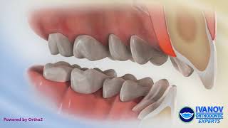 Teeth Before and After Overbite Fix with Braces [upl. by Sellihca]