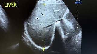 Normal liver giving false perception of hepatomegaly in COPD Liver is compressed transversely [upl. by Redan]