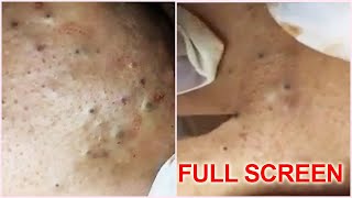 5 Years Old Blackheads Removal  Best Pimple Popping Videos [upl. by Pete]