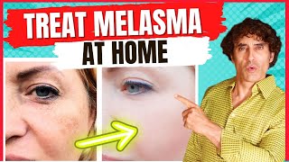 How to Treat MELASMA  Treat DARK SPOTS amp PATCHES on The SKIN [upl. by Spiegleman200]