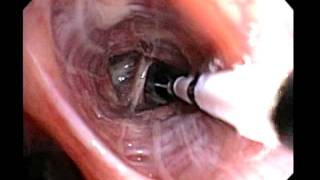 Bronchial Thermoplasty Improved Asthma Control for your Patients [upl. by Arratoon381]