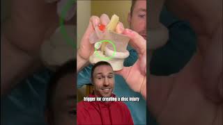 How to Fix a Disc Bulge WITHOUT SURGERY [upl. by Perzan]