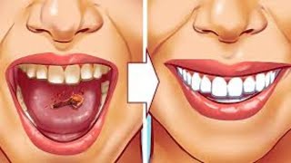 9 Natural Ways to Remove Plaque amp Tartar Buildup  Say Goodbye to Dental Problems [upl. by Penelope72]