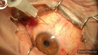 800 how to inject intravitreal to avoid endophthalmitis [upl. by Wixted]