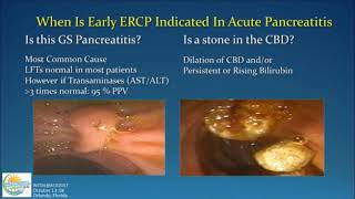 Management of Acute Pancreatitis [upl. by Davita15]