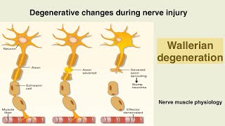 Wallerian degeneration  Nerve injury  peripheral nerve damage [upl. by Haimehen]