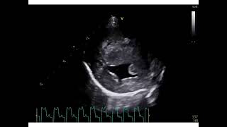 Neonatal hypertension Eisenmenger syndrome following a perimembranous ventricular septal defect [upl. by Ivey]