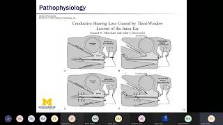 Superior Semicircular Canal Dehiscence  Dr Emily Stucken MD  University of Michigan [upl. by Noied125]