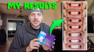 Whitebite Pro Teeth Whitening Kit Review  My 7 Day Results [upl. by Sabba]