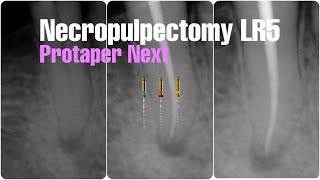 Root canal treatment lower right second premolar 45 protaper next [upl. by Trudey]