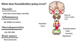 Bulbar vs pseudobulbar palsy [upl. by Balcer195]