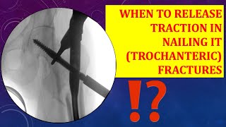 Traction release in trochanteric IT fracture nailining WHEN amp HOW MUCH [upl. by Novak]