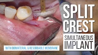 Split Crest with Simultaneous Implant with biomaterial amp resorbable membrane [upl. by Atalie524]