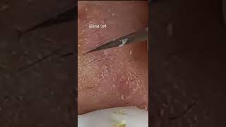 Pickel Ausdrücken Blackheads Akne amp Mitesser entfernen 🔴 18 [upl. by Randy]