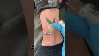 Tattoo Removal hwclinicbrugge [upl. by Anen]