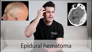 Epidural Hematoma \\ everything you need to know [upl. by Asilef864]