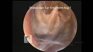 Similarities between cholesteatoma and cerumen embolism 20230807 [upl. by Bui]