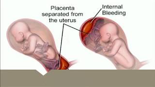 15 Perbedaan Plasenta Previa dan Solusio Plasenta yang Harus Diketahui Ibu Hamil [upl. by Williams179]