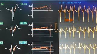 321 VOIR GUÉRIR CRISE DE TACHYCARDIE EN DIRECT EXTRASYSTOLE PALPITATIONS [upl. by Eelegna]