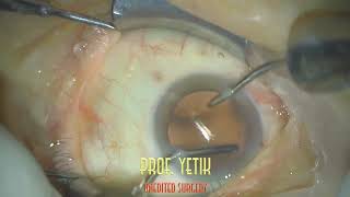 Katarakt Ameliyatı  Alcon UltraSert IOL  Cataract Surgery  Unedited Video  Prof Dr Hüseyin Yetik [upl. by Karp]