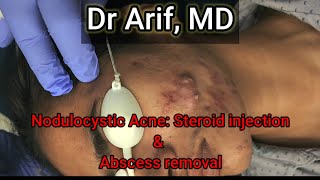 Nodulocystic acne Injection amp Abscess removal DrArifMDDermatologist acnetreatment acne dermatology [upl. by Niki520]