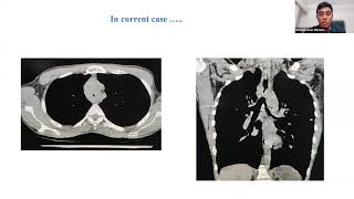 Central Airway Obstruction [upl. by Morty]